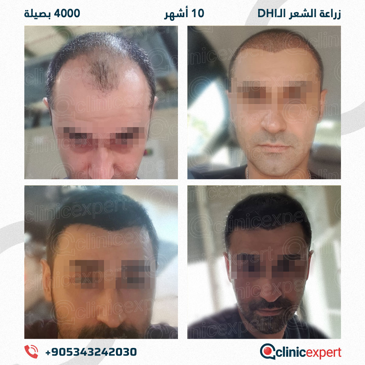 زراعة الشعر - 10 اشهر- 4000 بصيلة