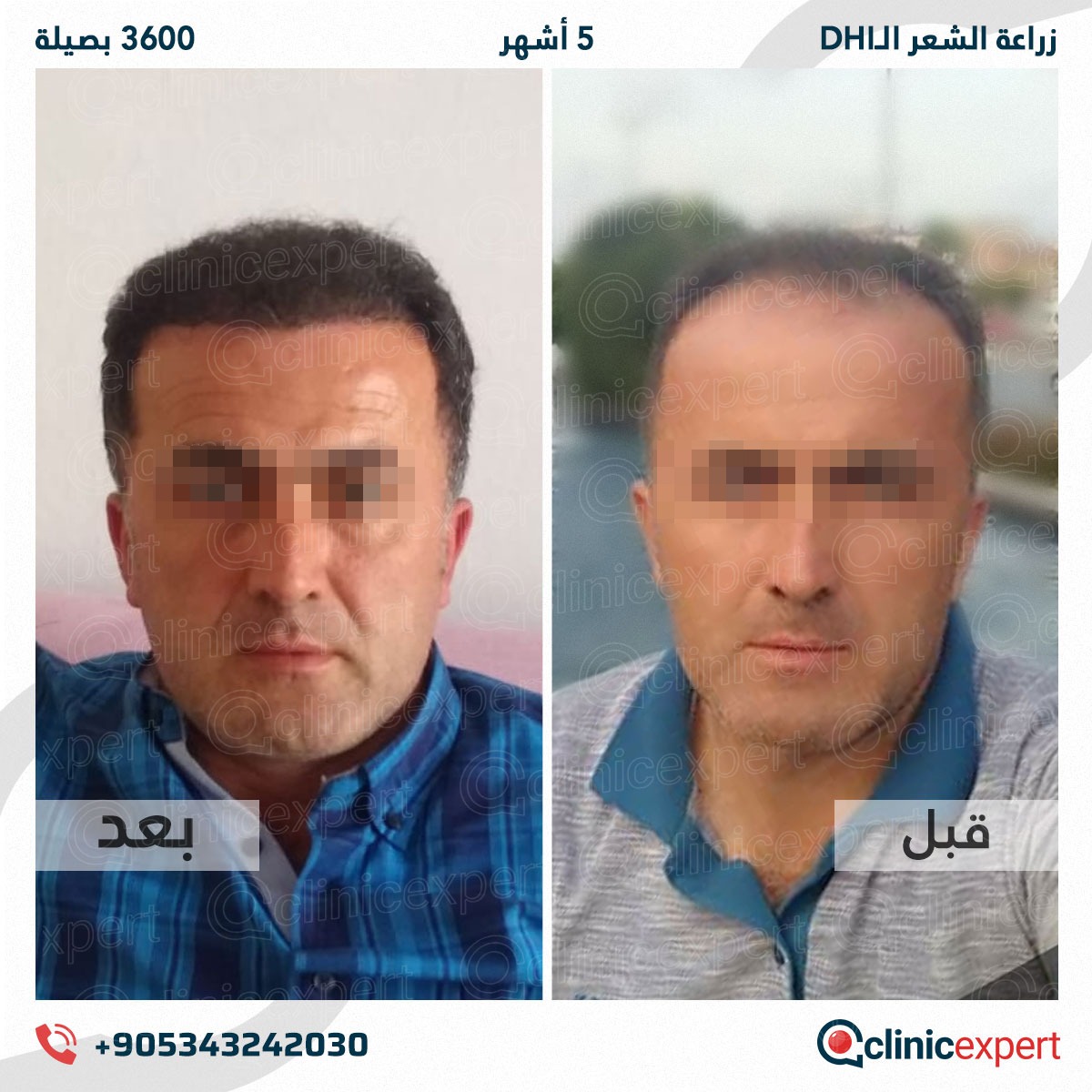 زراعة الشعر - 5 اشهر- 3600 بصيلة