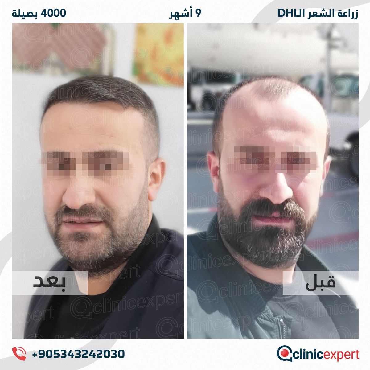 زراعة الشعر - 9 اشهر- 4000 بصيلة