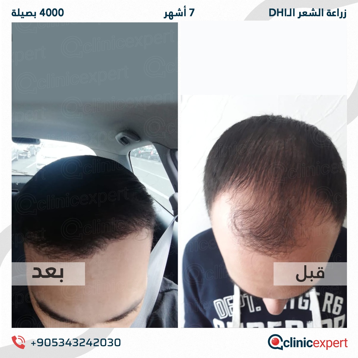 زراعة الشعر - 7 اشهر- 4000 بصيلة