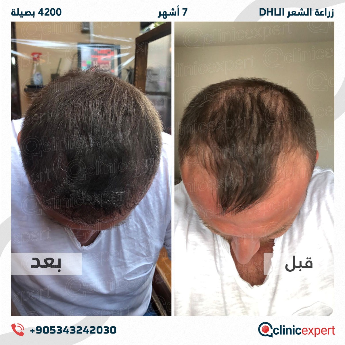 زراعة الشعر - 7 اشهر- 4200 بصيلة