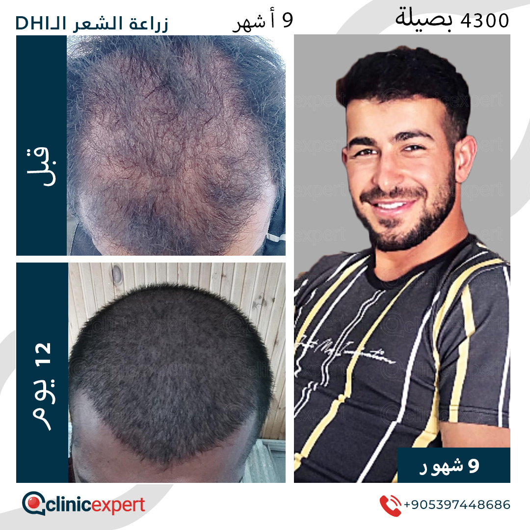 زراعة الشعر- 9 اشهر- 4300 بصيلة