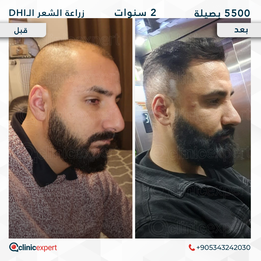 زراعة الشعر- 24 اشهر- 5500 بصيلة