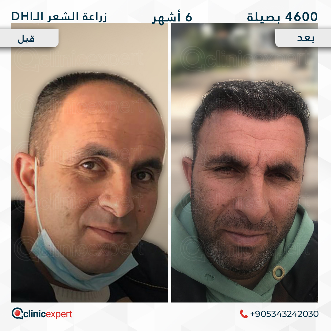 زراعة الشعر- 6 اشهر- 4600 بصيلة