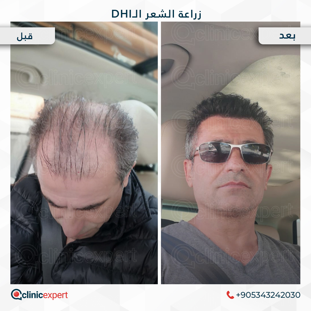 زراعة الشعر