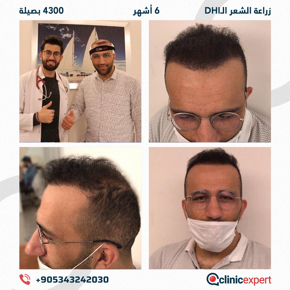 زراعة الشعر - 6 اشهر- 4300 بصيلة