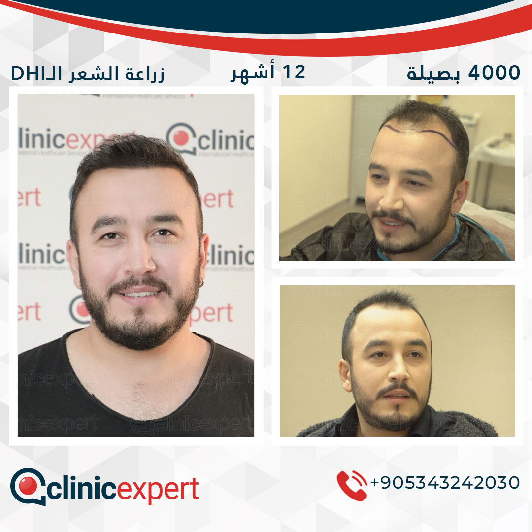 زراعة الشعر- 12 اشهر- 4000 بصيلة