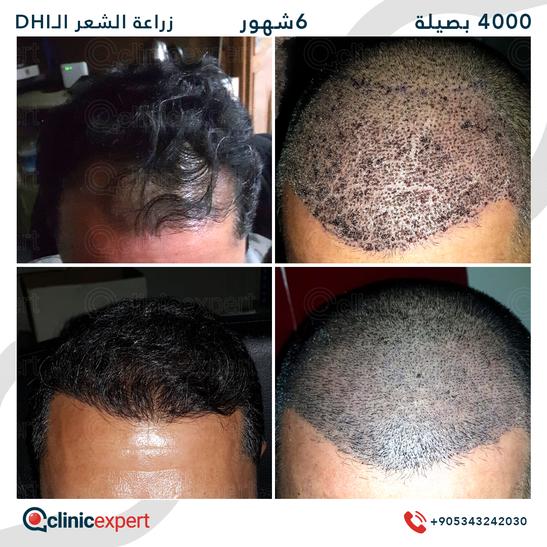 زراعة الشعر - 6 اشهر- 4000 بصيلة