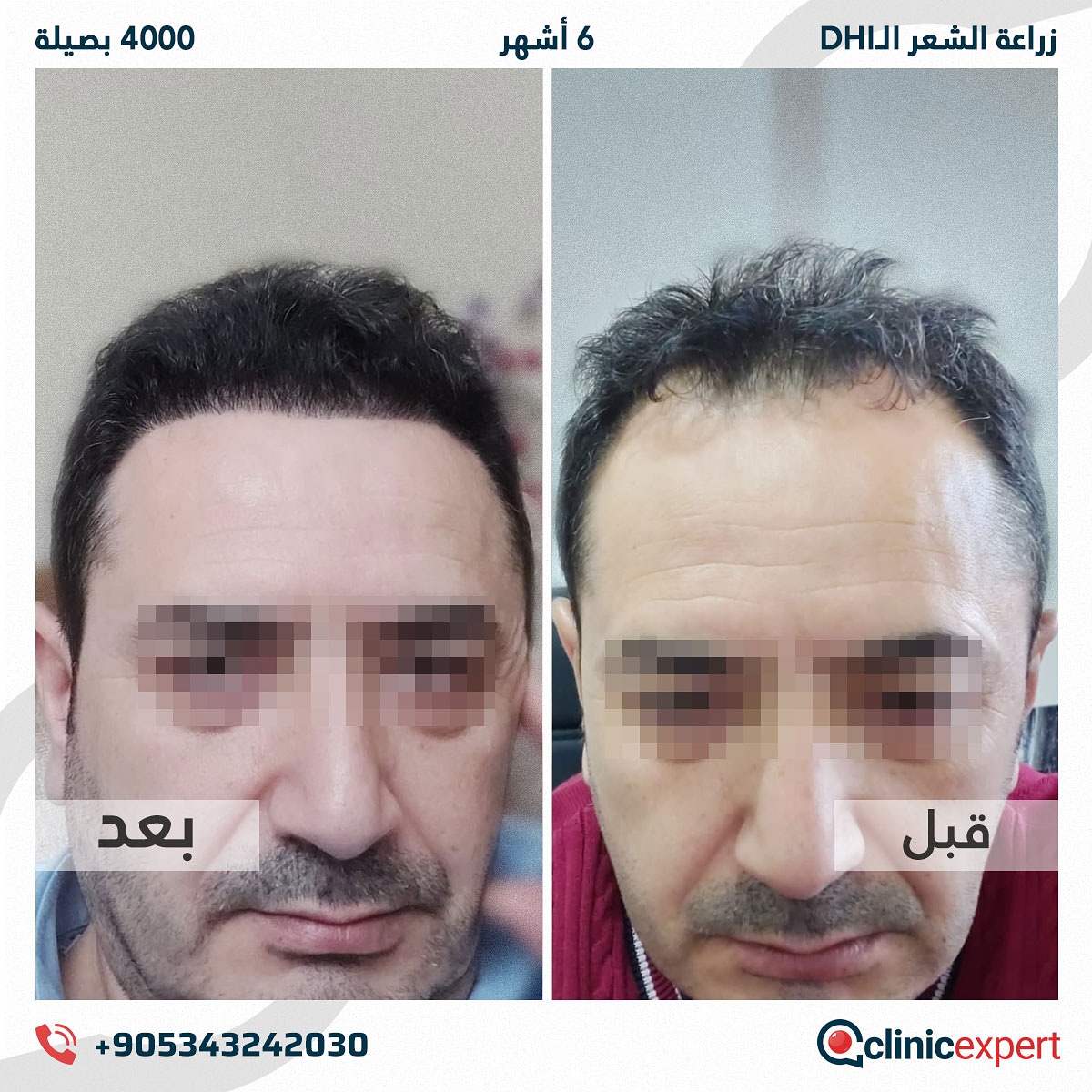 زراعة الشعر - 6 اشهر- 4000 بصيلة