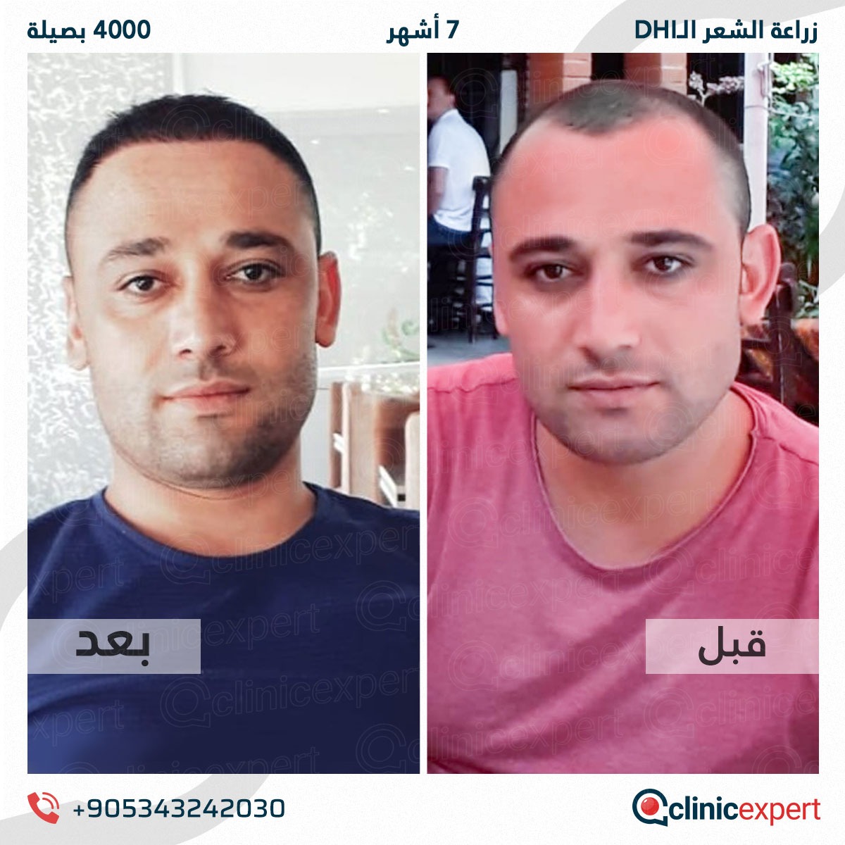 زراعة الشعر - 7 اشهر- 4000 بصيلة