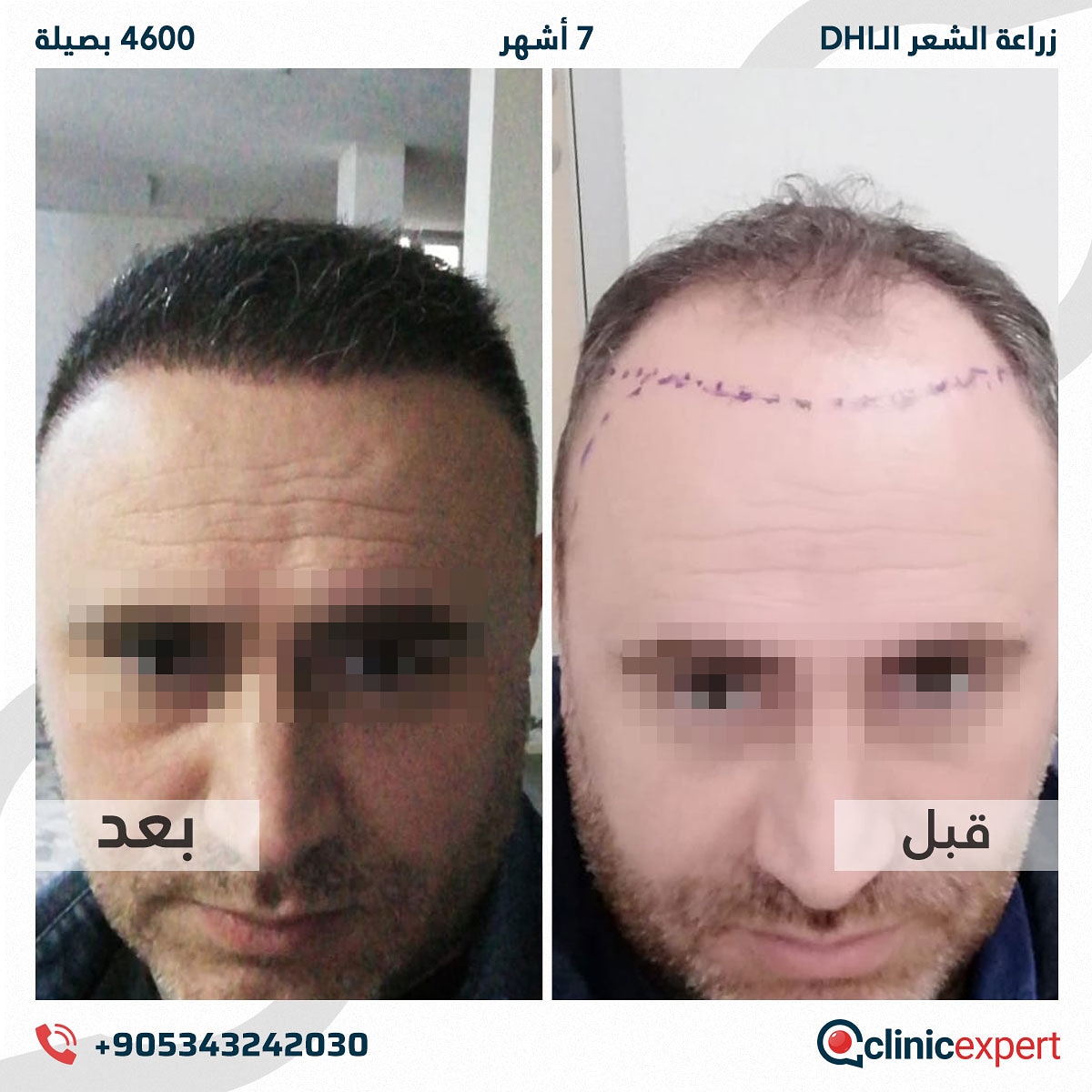 زراعة الشعر - 7 اشهر- 4600 بصيلة