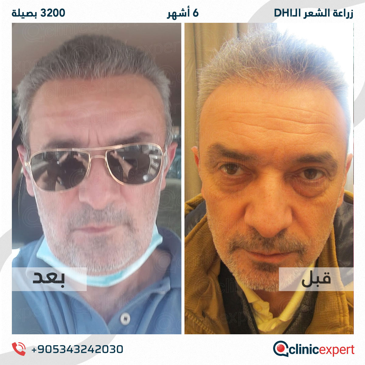 زراعة الشعر - 6 اشهر- 3200 بصيلة