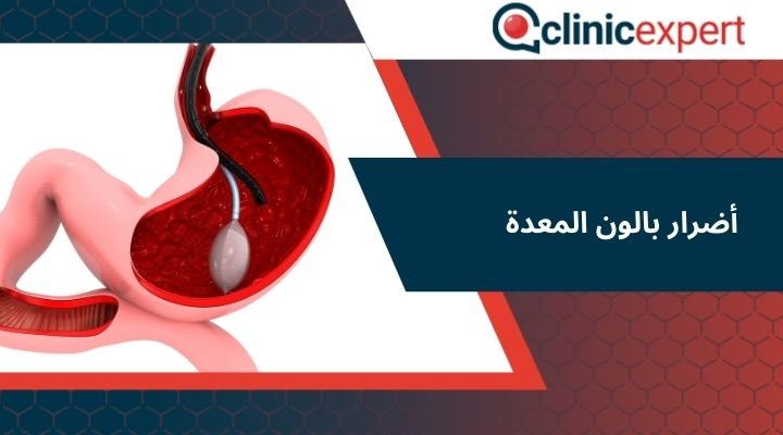 أضرار بالون المعدة