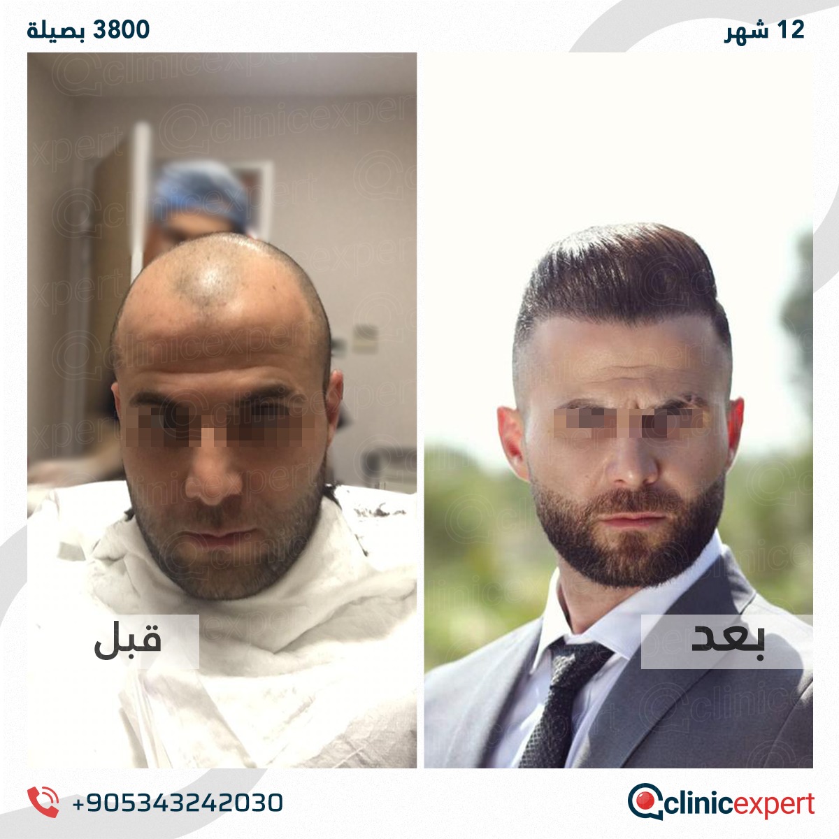 زراعة الشعر - 12 اشهر- 3800 بصيلة