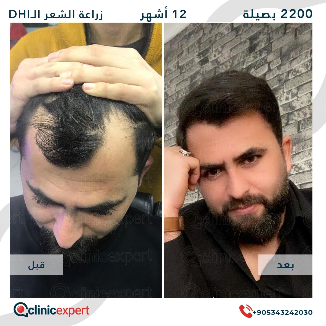 زراعة الشعر - 12 اشهر- 2200 بصيلة