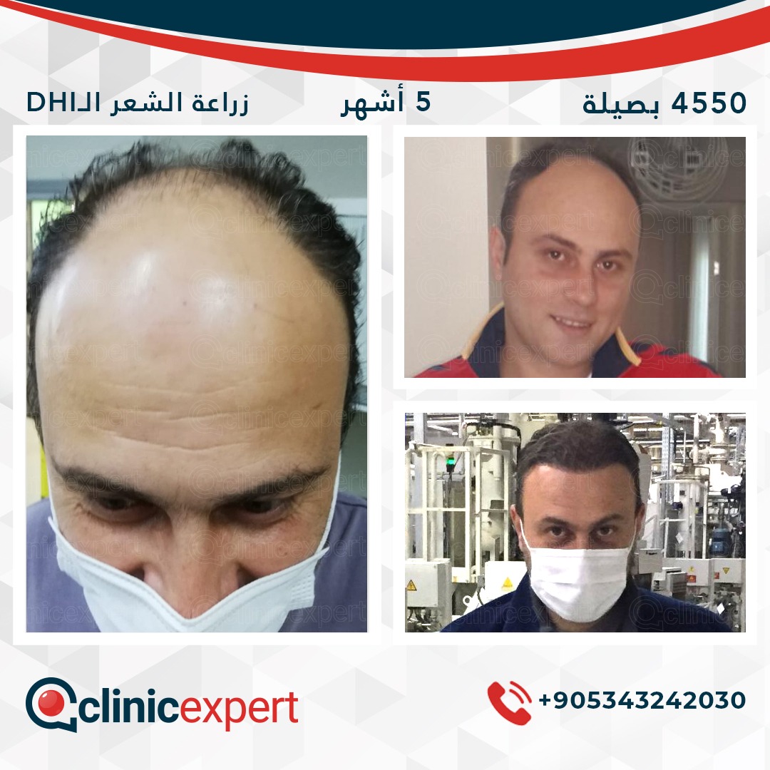 زراعة الشعر - 5 اشهر- 4450 بصيلة