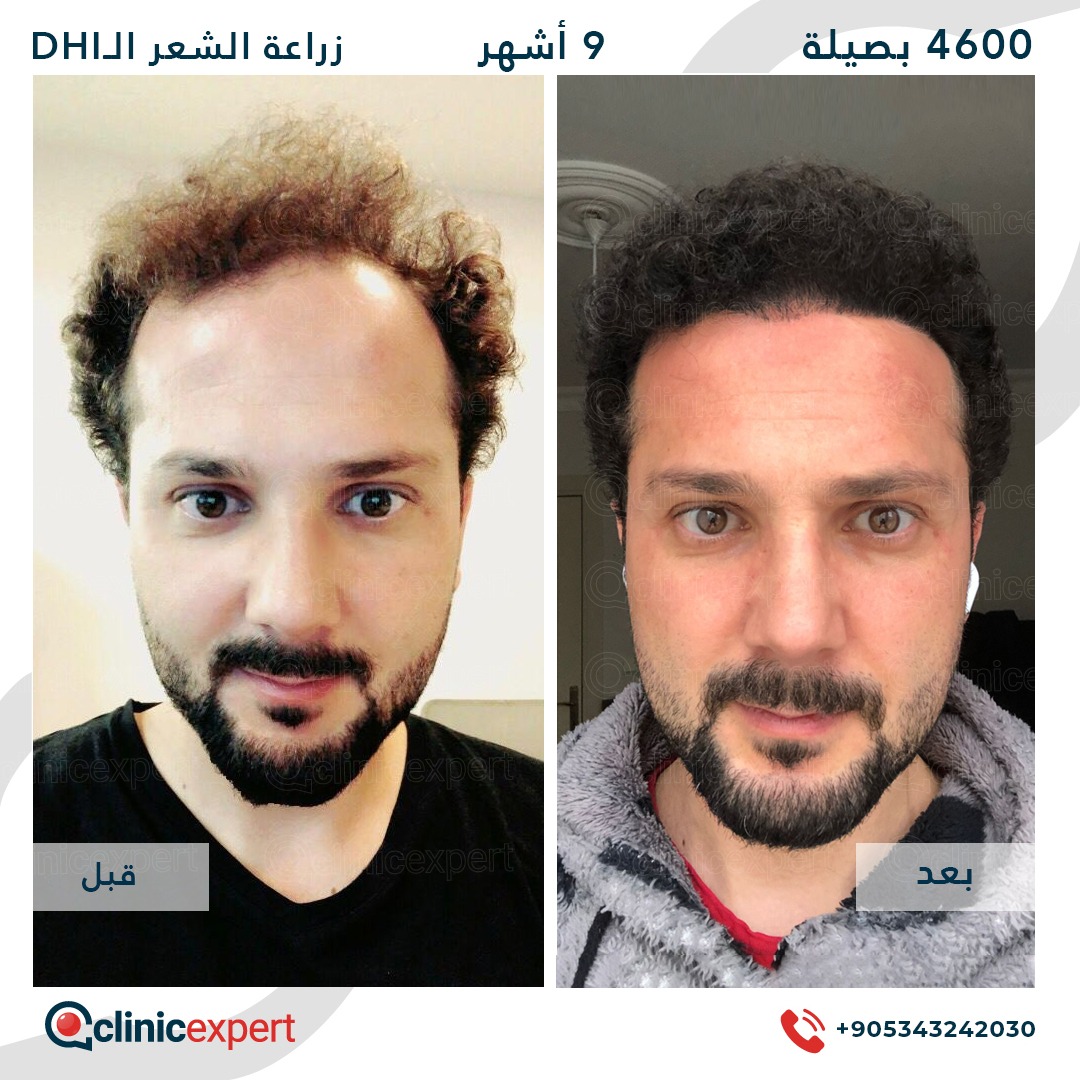 زراعة الشعر - 9 اشهر- 4600 بصيلة