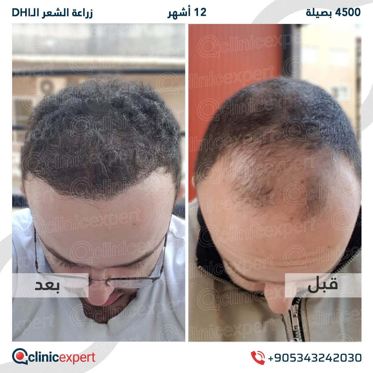 زراعة الشعر - 12 اشهر- 4500 بصيلة