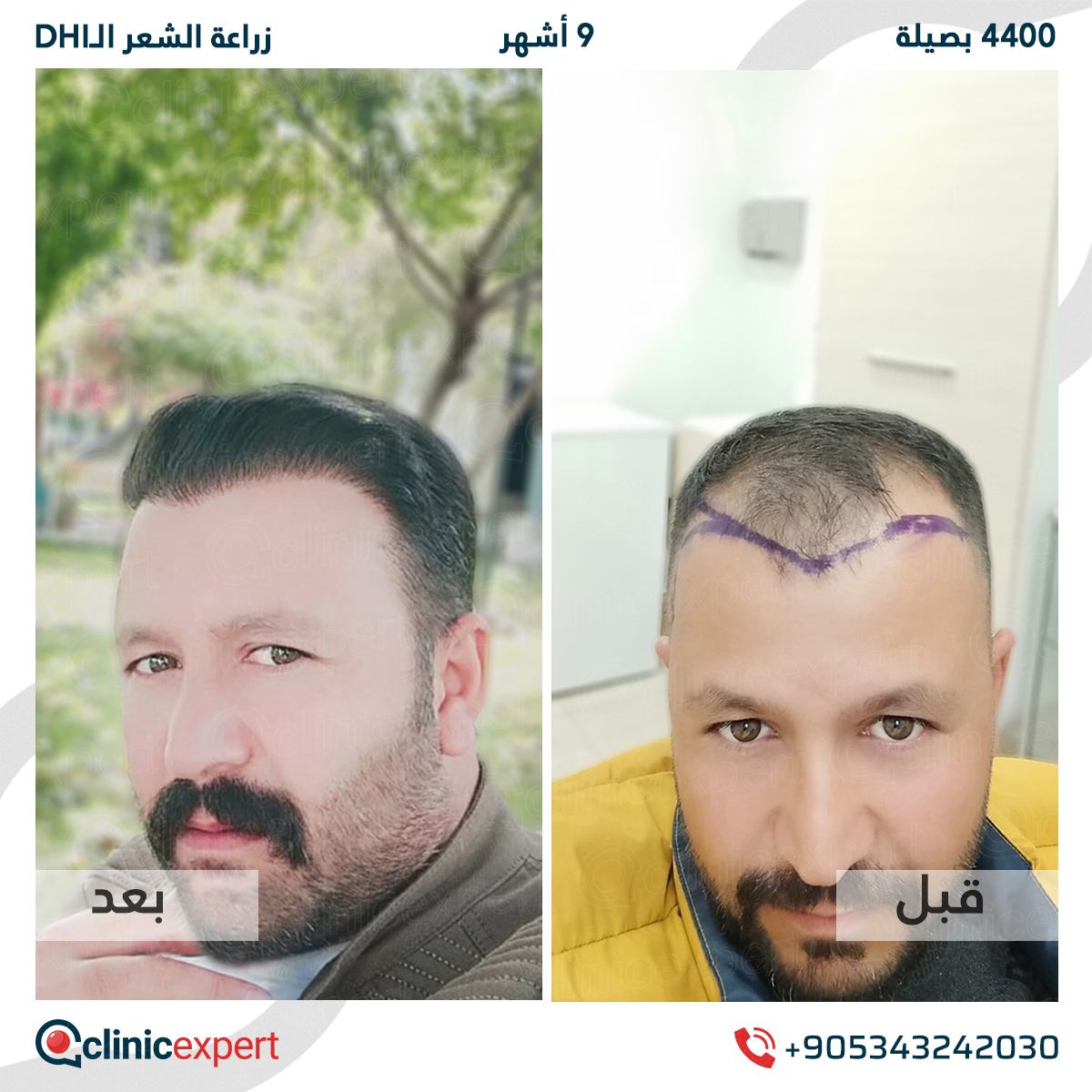 زراعة الشعر - 9 اشهر- 4400 بصيلة