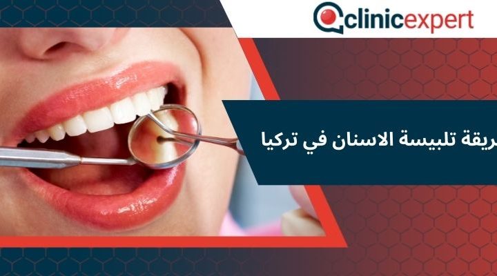 طريقة تلبيسة الاسنان في تركيا