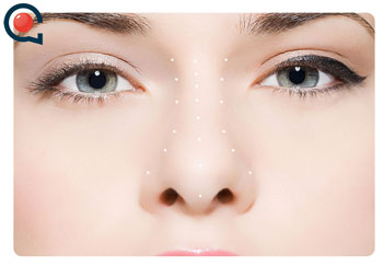 GEKRÜMMTE NASENSCHEIDEWAND OP