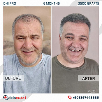 Hair Transplant Hair Transplant