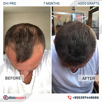 Hair Transplant Hair Transplant