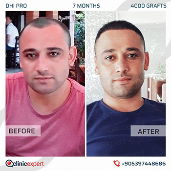 Hair Transplant Hair Transplant