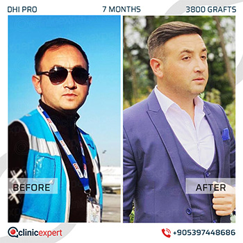Hair Transplant Hair Transplant