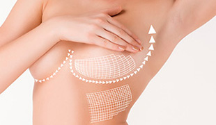 Breast Lift