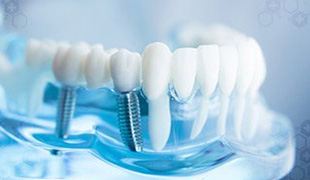 Dental Implants