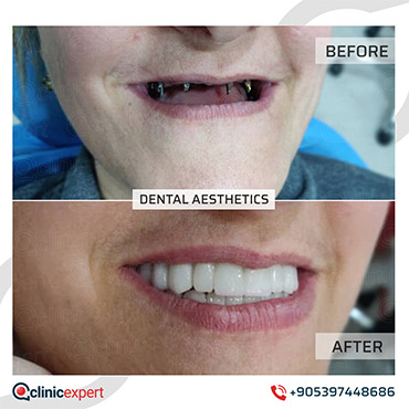 Dental implants Dental implants