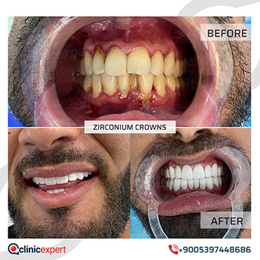 Zirconium Crowns Zirconium Crowns