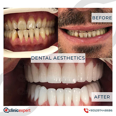 Dental Aesthetic Dental Aesthetic