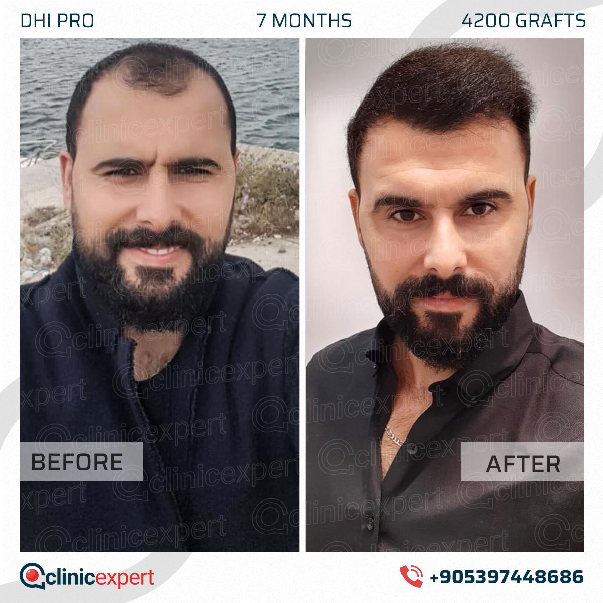 Hair Transplant