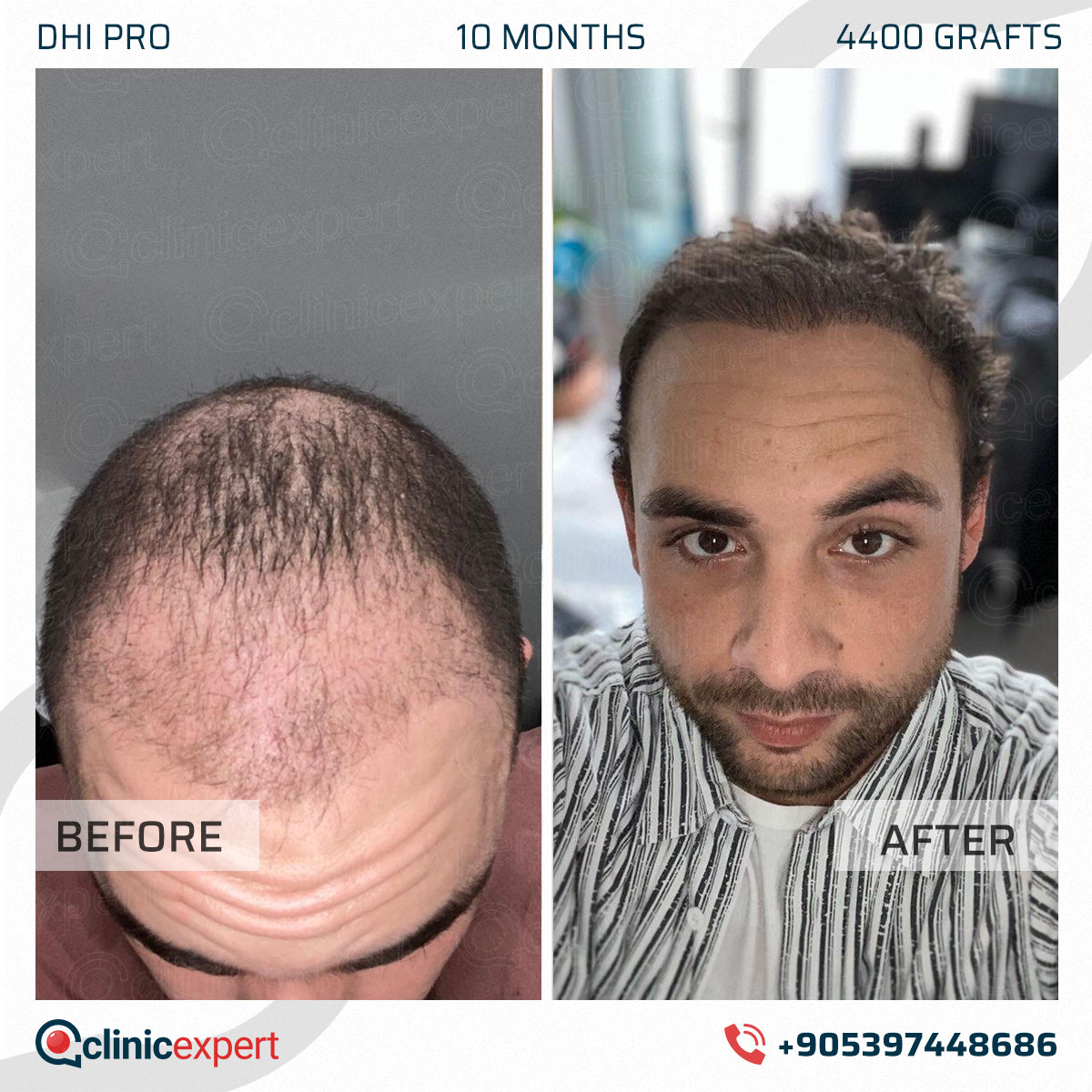 Hair Transplant
