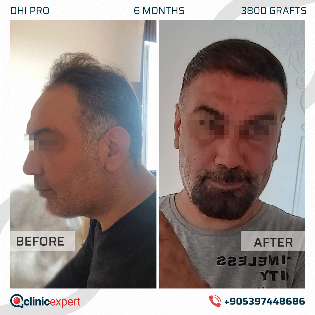 Hair Transplant
