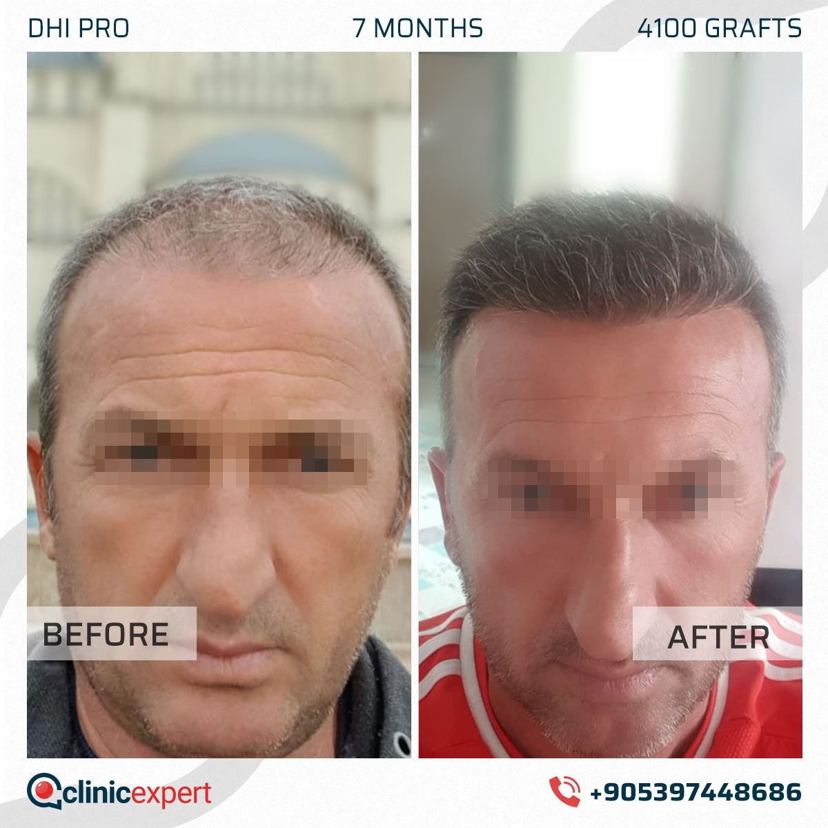Hair Transplant