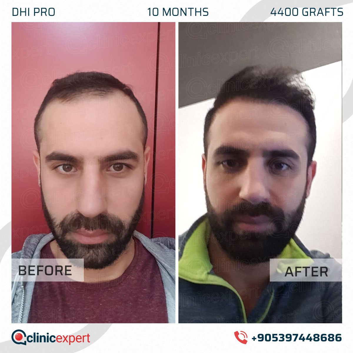 Hair Transplant