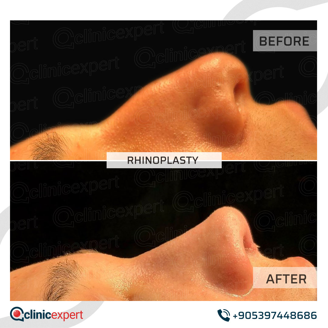 Rhinoplasty