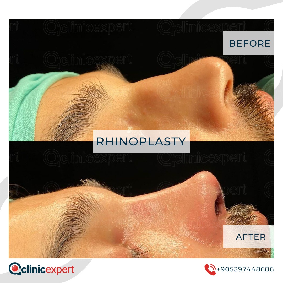 Rhinoplasty