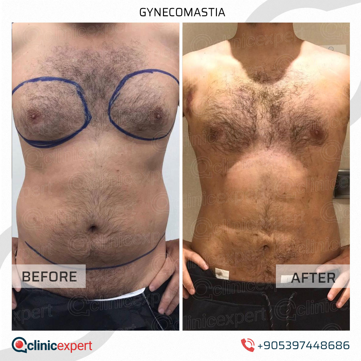 Gynecomastia