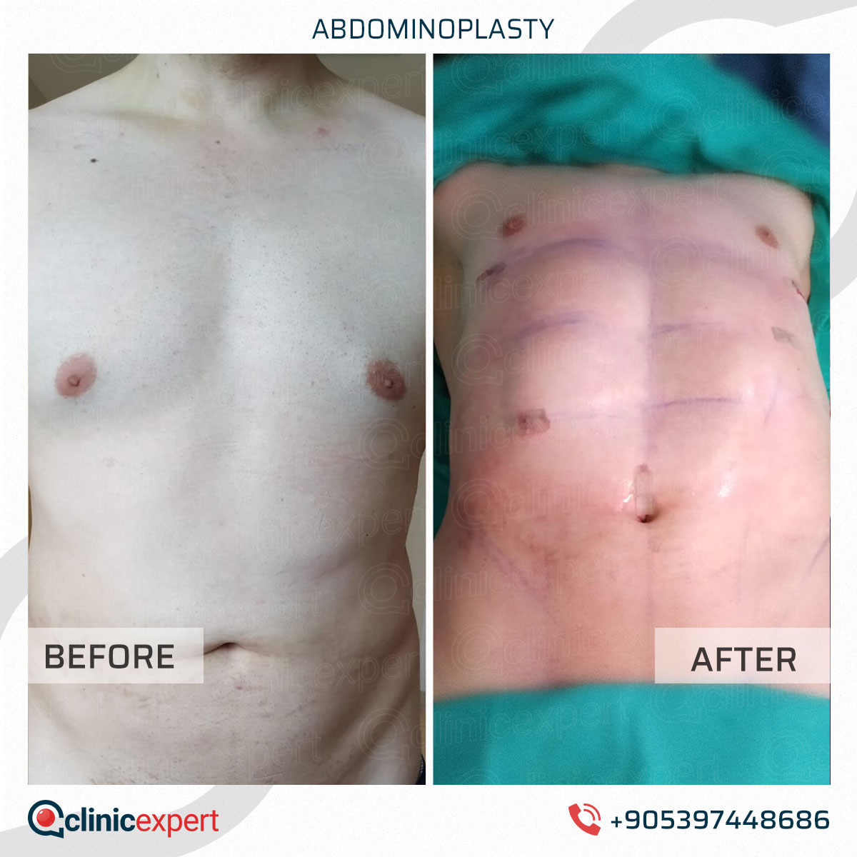 Abdominoplasty