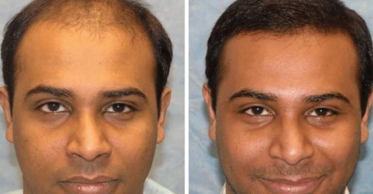 Best Hair Transplant Surgery