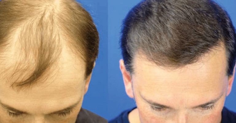 Best Hairline Transplant Surgeon