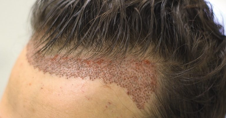 Can I Use Hair Fibres After Hair Transplant?