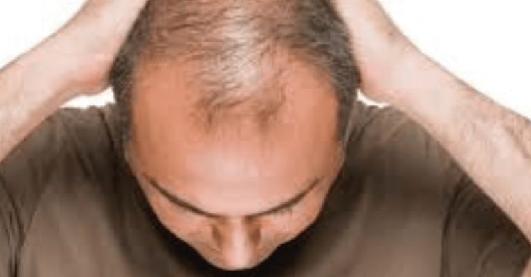 Hair Growth Surgery