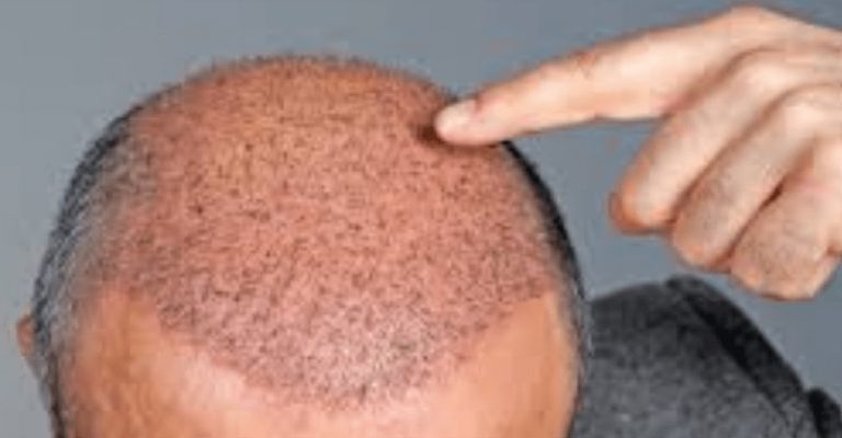 Hair Loss Replacement Surgery