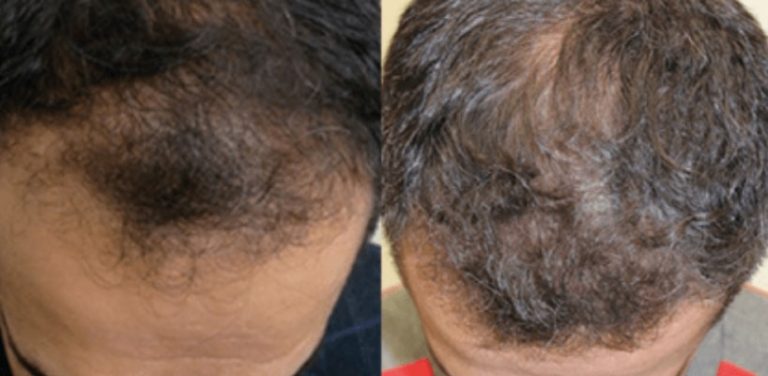 Hair Reconstruction Procedure | ClinicExpert