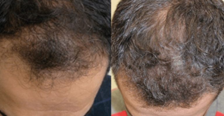 Hair Reconstruction Procedure